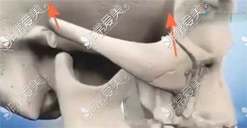 颧骨颧弓整形手术动画图