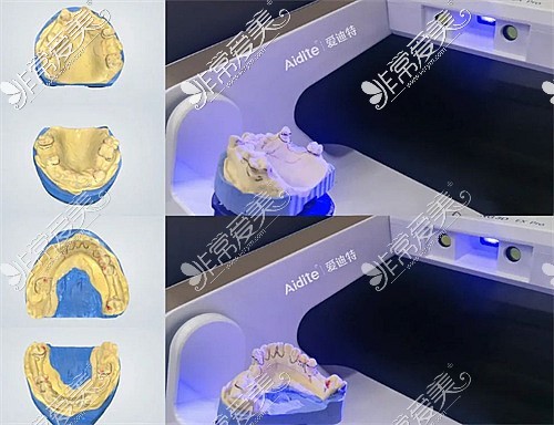 全瓷牙制作示意图