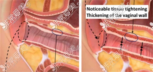 菲蜜丽治疗阴道紧缩后内壁增厚