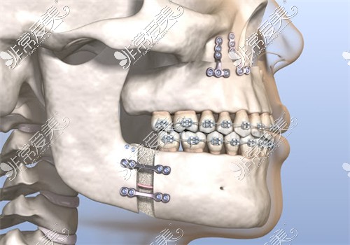 正颌手术展示图