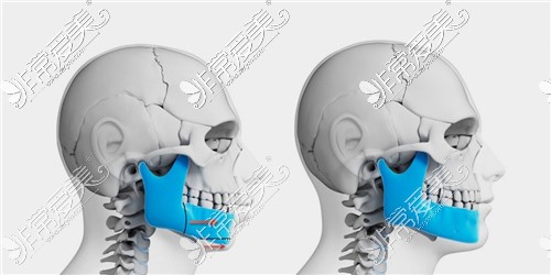 正颌手术动画对比图