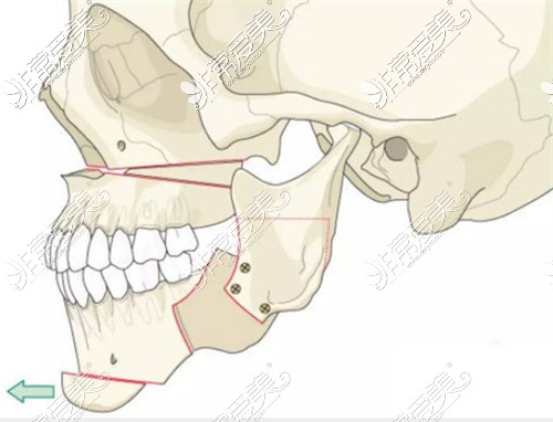 正颌手术展示图