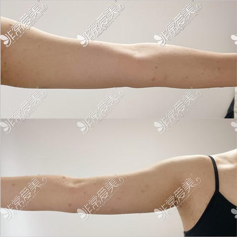 韩国365mc手臂吸脂案图片对比
