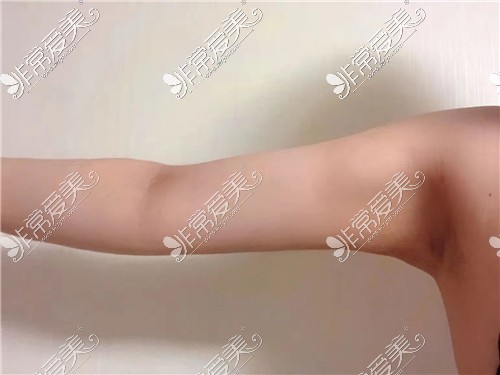 韩国WIZ&美医院手臂吸脂2个月