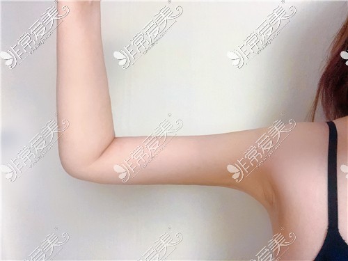 韩国WIZ&美医院手臂吸脂3个月