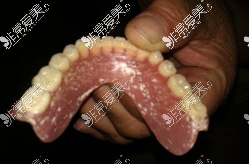 吸附性牙齿照片