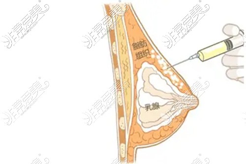 自體脂肪操作展示圖