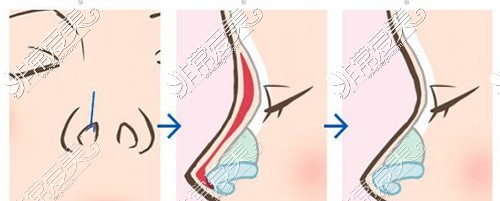 要说南通隆鼻多少钱?还得从做鼻子好的医院医生收费价格看