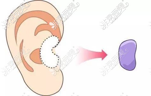 耳软骨隆鼻示意图