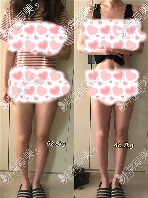 韩国美尔韩方医院小粉丸瘦6kg对比