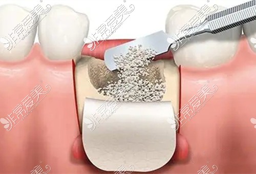 种植牙骨粉多少钱
