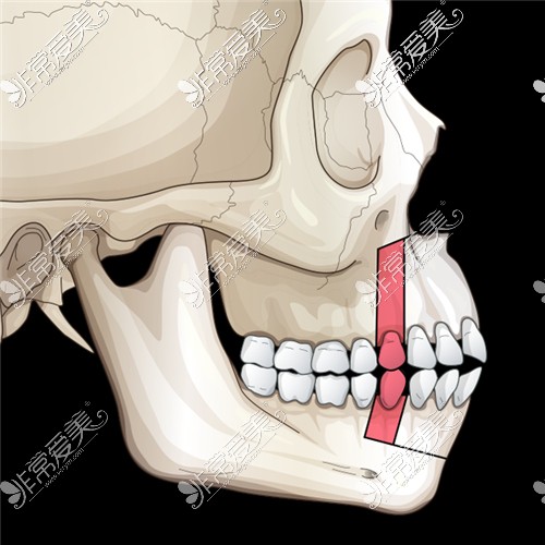 颌骨发育导致的嘴突