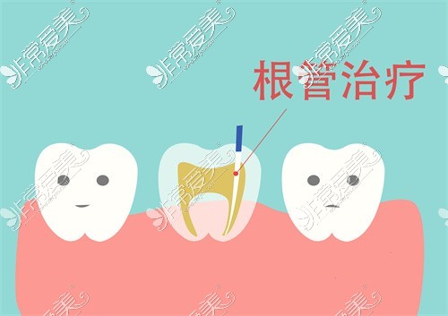 根管治療示意圖