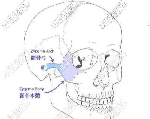 顴骨改善治療卡通圖展示