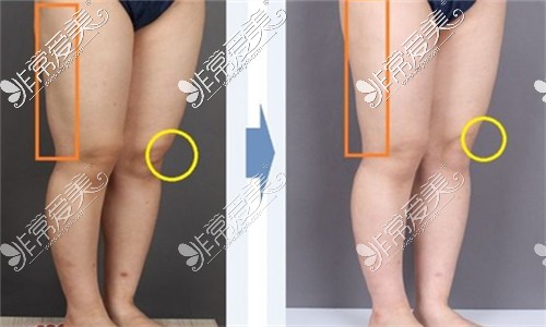 韩国365mc吸脂医院大腿吸脂修复对比