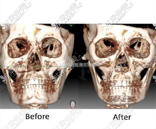 面部骨骼CT照片