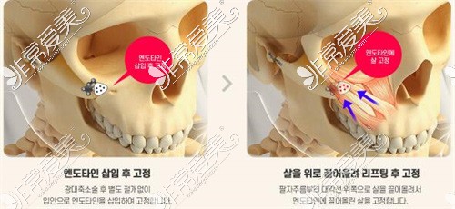 做颧骨手术会不会导致面部下垂?韩国必妩跟1%整形有妙招！
