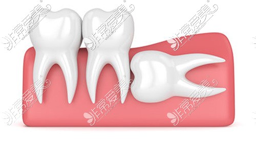横向埋伏阻生智齿
