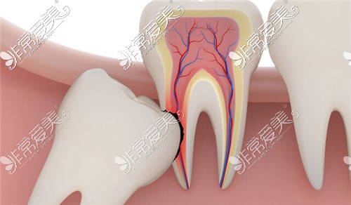 低位阻生智齿图片