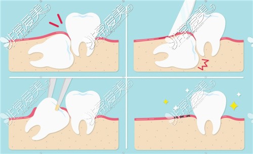 上颌智齿拔除步骤动画图片