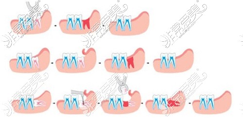 不同类型智齿拔除