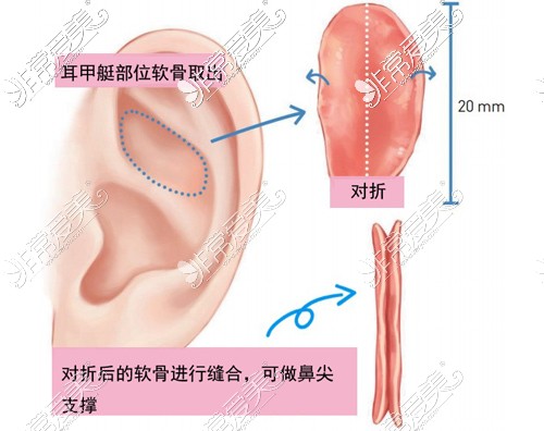 北京做耳软骨鼻子大概多少钱?带你了解耳软骨隆鼻市场价