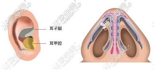 耳軟骨取骨部位和固定方式