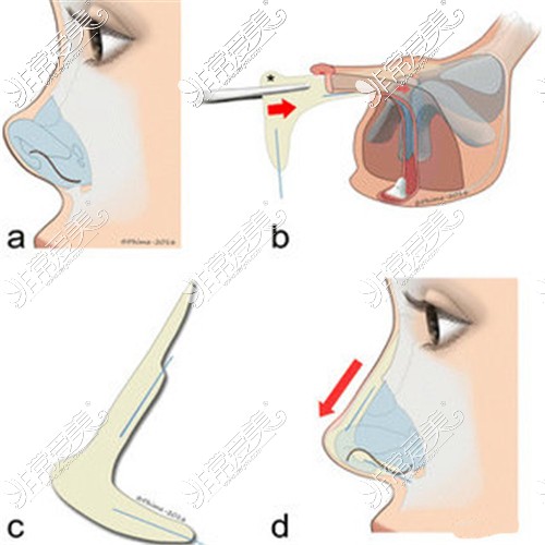 鼻部整形示意图
