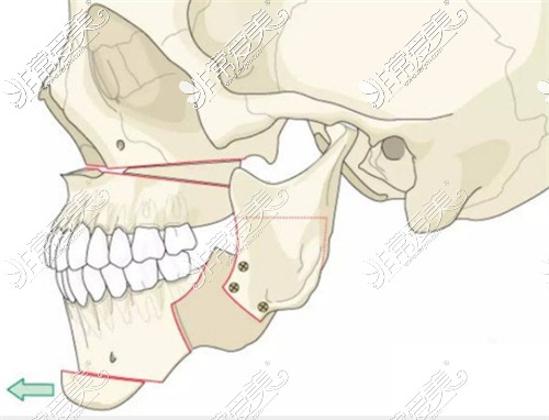 正颌手术动画图