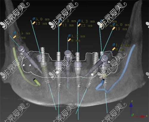 阆中麒麟牙科数字化种植牙示意图