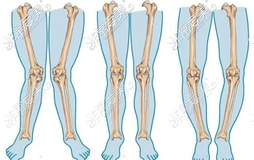 不同腿型展示图