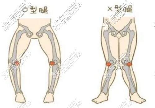 O型腿和X型腿