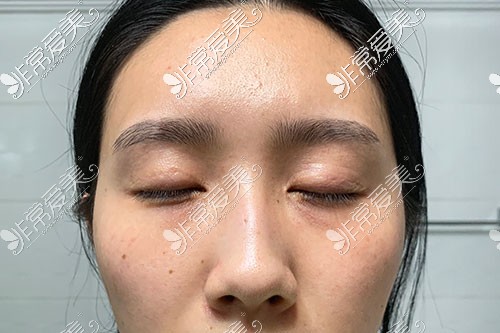 韩国可来熙整形外科双眼皮修复术前图