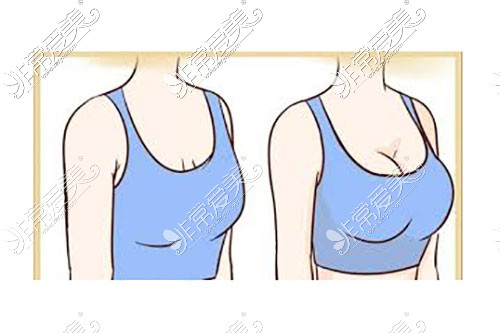 胸部下垂矫正前后对比示意图