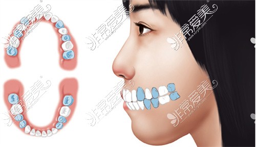 儿童牙齿矫正示意图