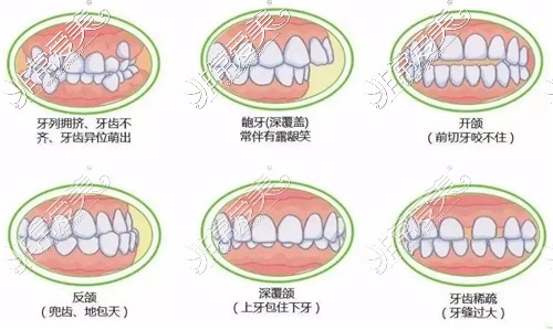 不同的牙齿畸形情况