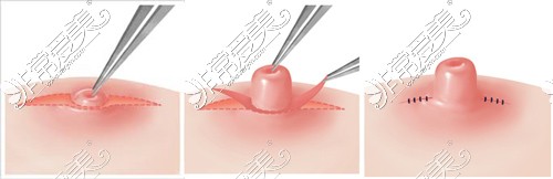 輕度乳頭內(nèi)陷矯正過程