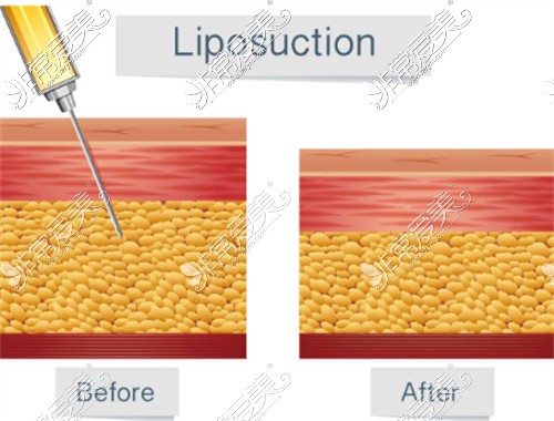 成都大华医院吸脂对比图