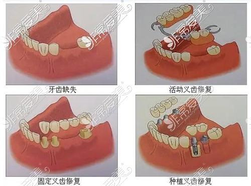 牙齿缺失修复种类