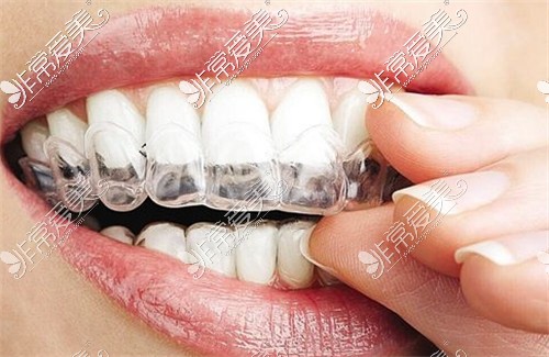 淘宝买的牙套竟然把牙齿矫正好了，来看是不是智商税!