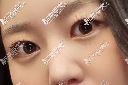韩国来丽整形医院双眼皮改单眼皮手术后图