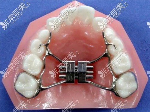 矫正牙齿扩张器图片图片