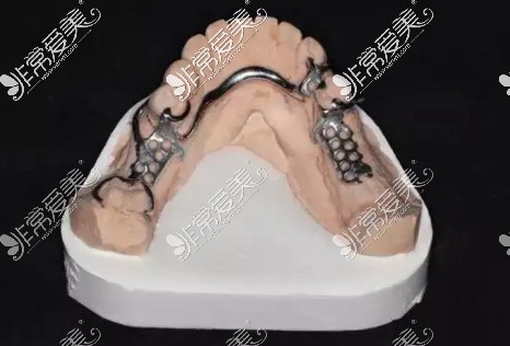 维他灵支架是什么材料？做假牙真的不会对人体造成危害吗