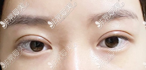 韩国可来熙双眼皮修复后一个月