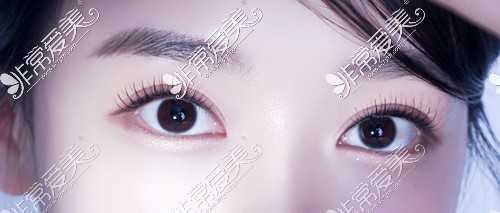 韩国可来熙双眼皮修复后两个月