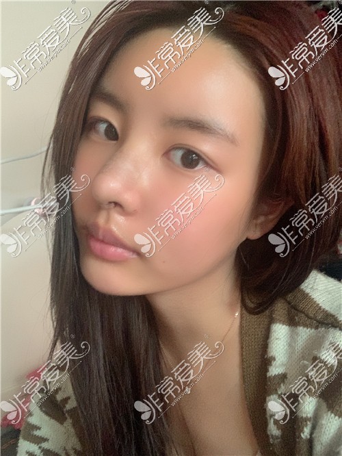歌柔飞整形医院鼻部整形术后 歌柔飞整形医院鼻部整形术后