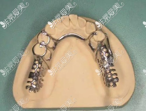 假牙支架多少钱一个？以及假牙支架什么材质最好？