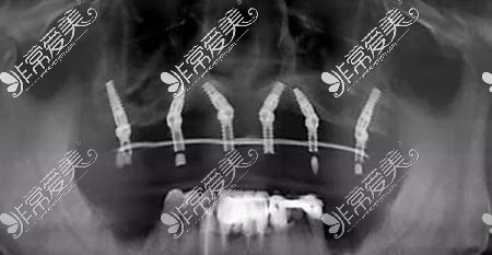 种植牙术后ct照