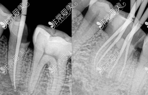 根管治疗ct照