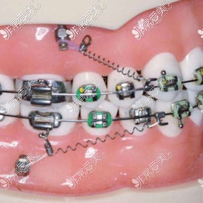 牙齿矫正过程图解